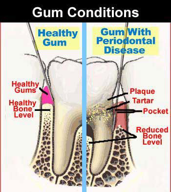 gum-disease2