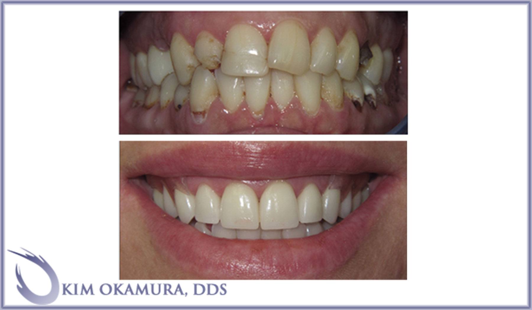 before-and-after-cosmetic-dentistry