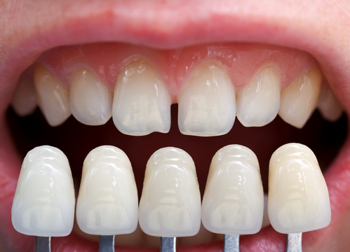 Cleaning Your Invisalign Trays (Our Best Tips And Tricks!) - Dr. Kim  Okamura DDS