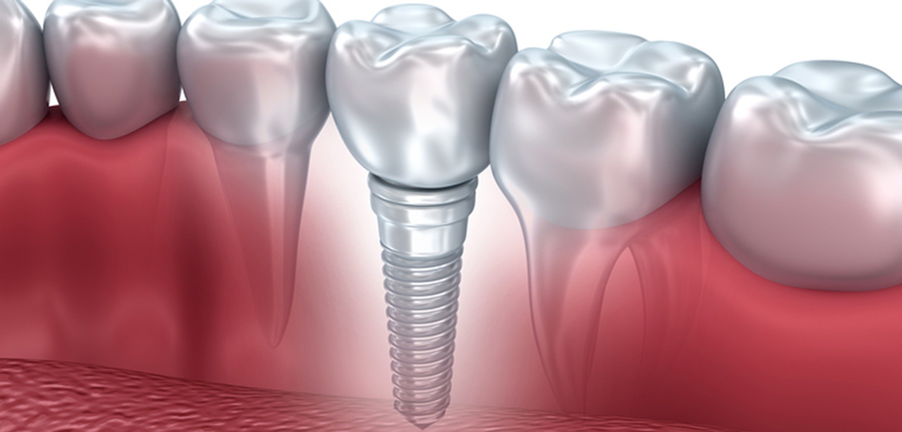 Tooth human implant, 3d illustration