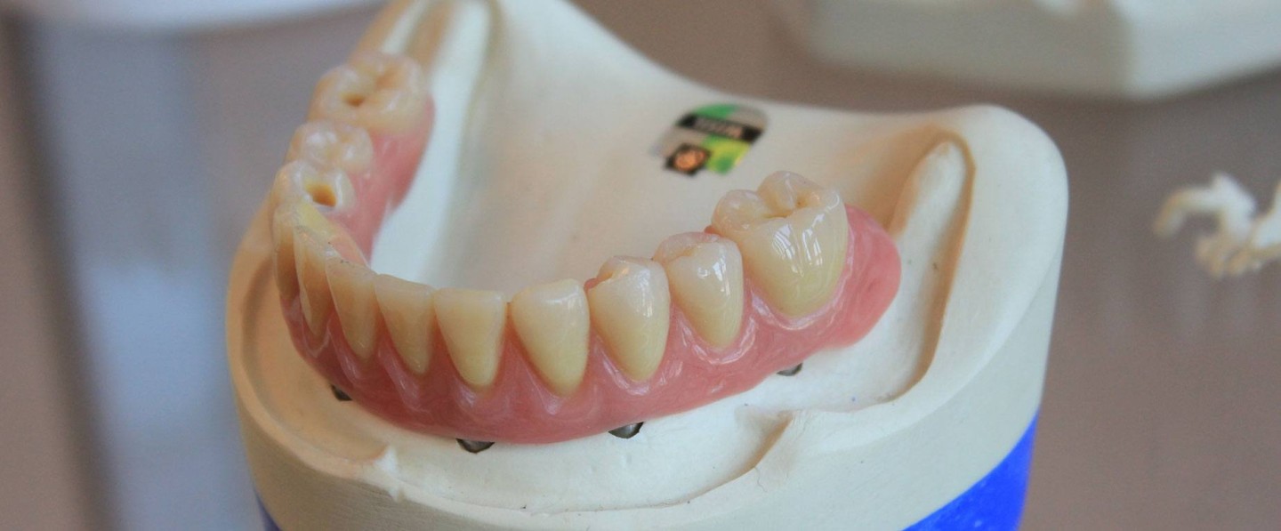newest-dental-crowns